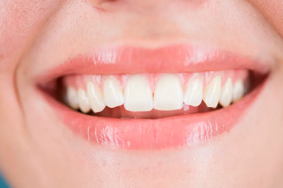 Imagen de sonrisa después del tratamiento de ortodoncia